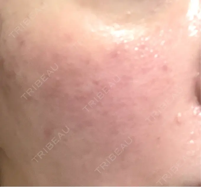 肌育注射（ジュベルックなど） / リジュラン SUNMELIA SKIN CLINIC DAY 1 メイン用