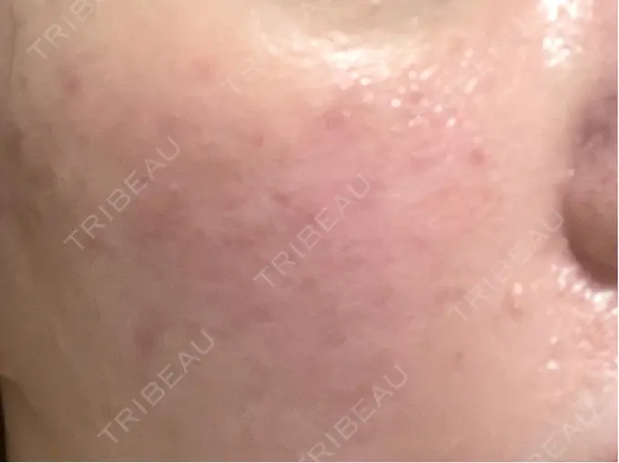 肌育注射（ジュベルックなど） / リジュラン SUNMELIA SKIN CLINIC DAY 1 メイン用