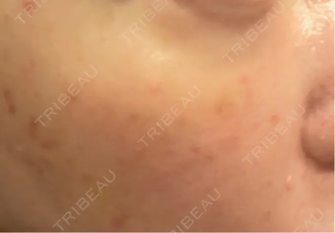 肌育注射（ジュベルックなど） / リジュラン SUNMELIA SKIN CLINIC AFTER メイン用