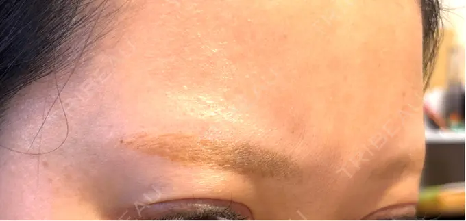 アートメイク除去・修正 ライズワン美容皮膚科クリニック DAY 7 メイン用