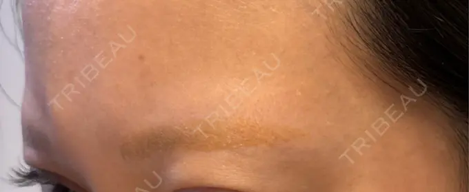 アートメイク除去・修正 ライズワン美容皮膚科クリニック DAY 7 メイン用