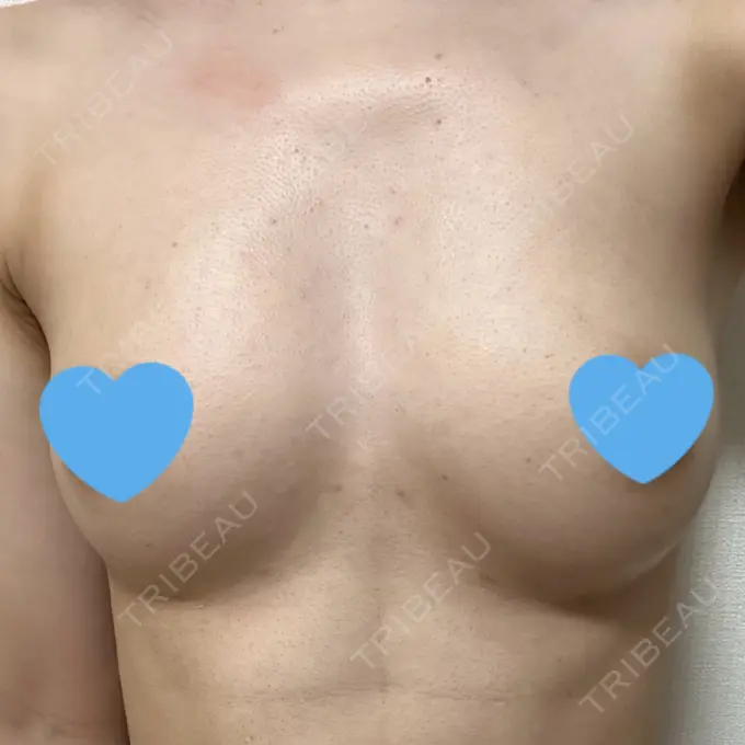 豊胸（脂肪注入） Bloom Delight Clinic DAY 102 メイン用