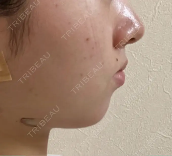 ヒアルロン酸注入（あご） / ボトックス（肩） HAAB BEAUTY CLINIC 名古屋院 AFTER メイン用