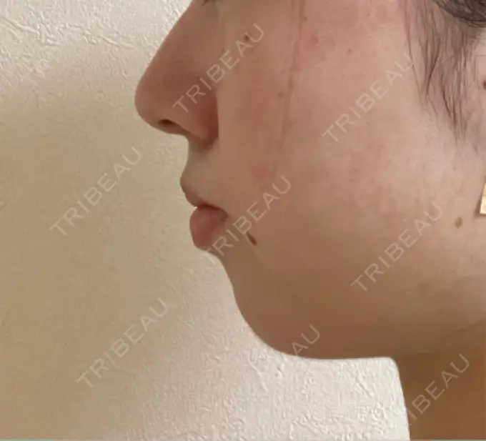 ヒアルロン酸注入（あご） / ボトックス（肩） HAAB BEAUTY CLINIC 名古屋院 DAY 38 メイン用