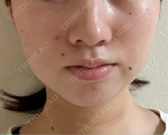 ヒアルロン酸注入（あご） / ボトックス（肩） HAAB BEAUTY CLINIC 名古屋院 DAY 38 メイン用