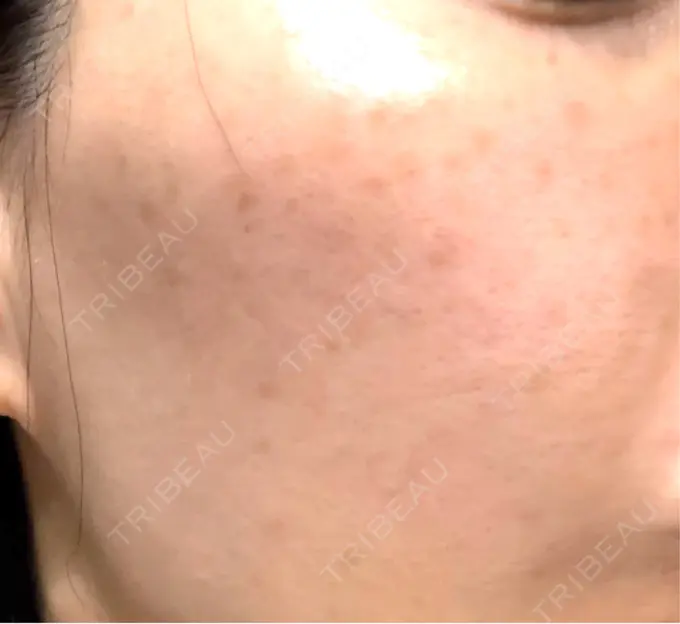 イオン導入 / ピーリング（ハリ・ツヤ） / ルメッカ ルラ美容クリニック 名古屋栄院 / ルラスキンクリニック 名古屋栄院 DAY 10 メイン用