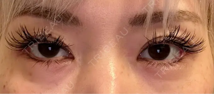 目尻切開 / タレ目形成・グラマラスライン（埋没） LOUIS CLINIC 二子玉川院【ルイクリニック】 DAY 8 メイン用