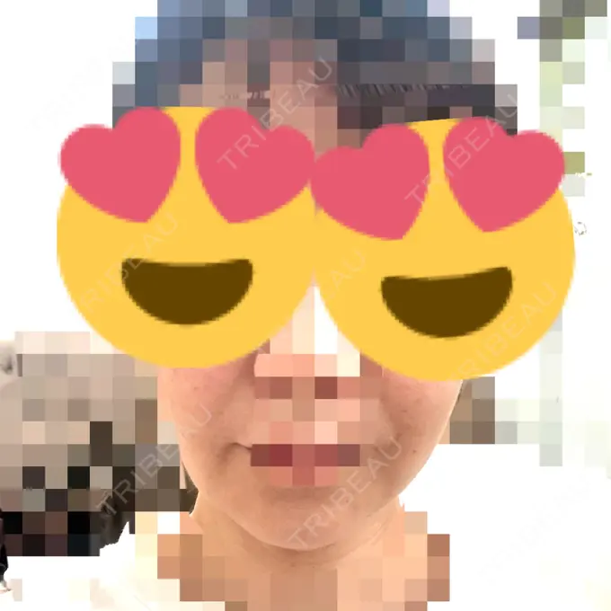 糸リフト アリエル美容クリニック 横浜院 DAY 18 メイン用