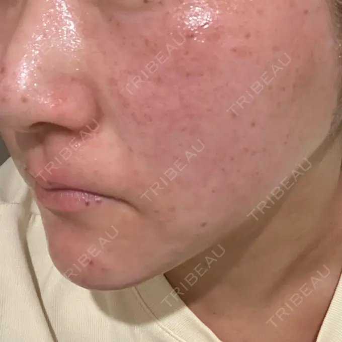 ルビーレーザー Designo Clinic （デジーノクリニック） DAY 0 メイン用