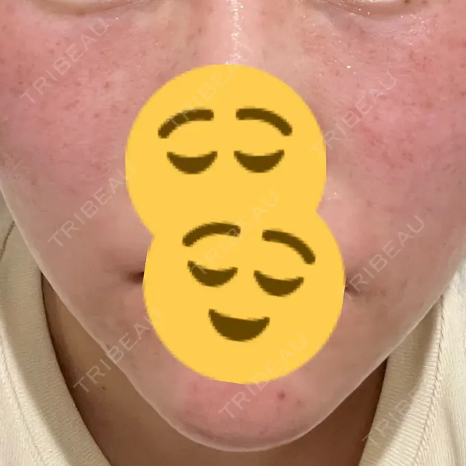 ルビーレーザー Designo Clinic （デジーノクリニック） DAY 0 メイン用