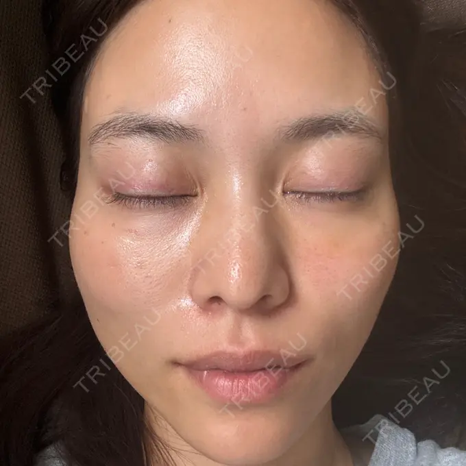 ボトックス（肩） / 肌育注射（ジュベルックなど） APスキンクリニック銀座 DAY 39 メイン用