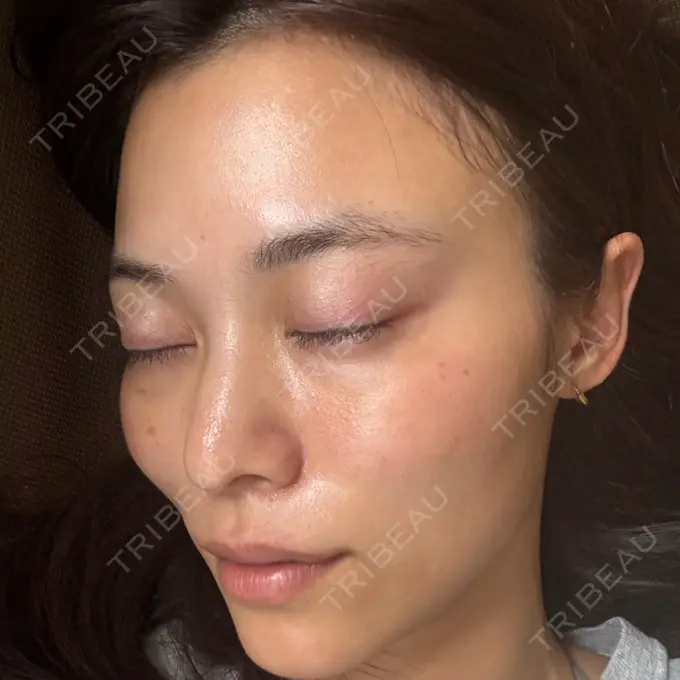 ボトックス（肩） / 肌育注射（ジュベルックなど） APスキンクリニック銀座 DAY 39 メイン用