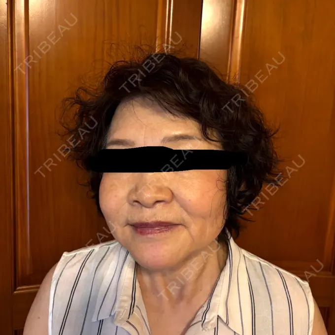 RF（高周波）たるみ治療 共立美容 池袋院 DAY 71 メイン用