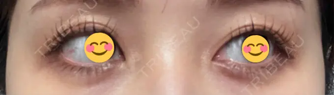 ヒアルロン酸注入（涙袋） AI Beauty Clinic （エーアイ美容クリニック） DAY 0 メイン用