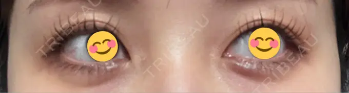 ヒアルロン酸注入（涙袋） AI Beauty Clinic （エーアイ美容クリニック） DAY 0 メイン用