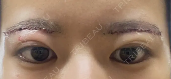 眉下切開 PRO CLINIC プロクリニック 銀座院 DAY 0 メイン用