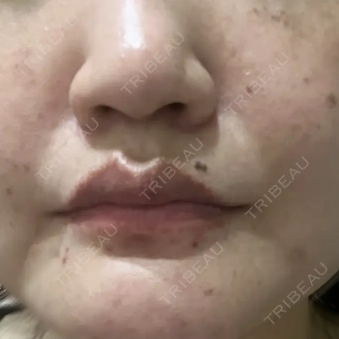 ピコレーザートーニング（美白・肝斑） 東京シルククリニック 東京神田院 DAY 3 メイン用