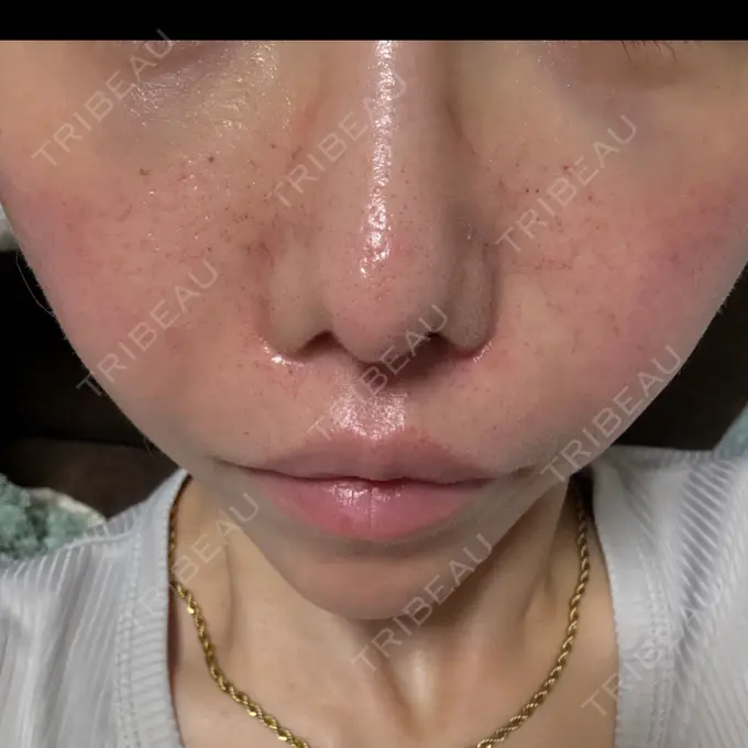 リジュラン しんゆり美容健康クリニック AFTER メイン用