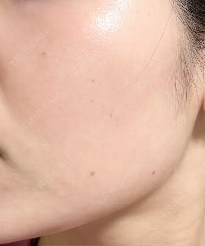 美肌レーザー / 美白レーザー / YAGレーザー / レーザーフェイシャル / 赤み除去レーザー AI Beauty Clinic （エーアイ美容クリニック） AFTER メイン用