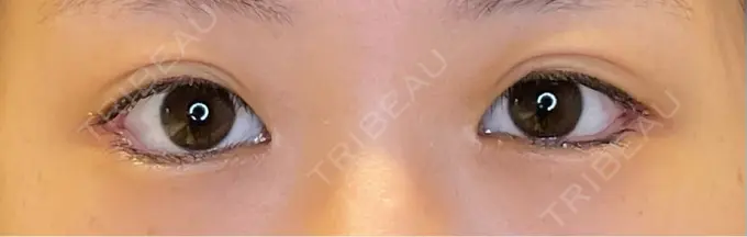 目尻切開 / タレ目形成・グラマラスライン（埋没） LOUIS CLINIC 二子玉川院【ルイクリニック】 DAY 6 メイン用