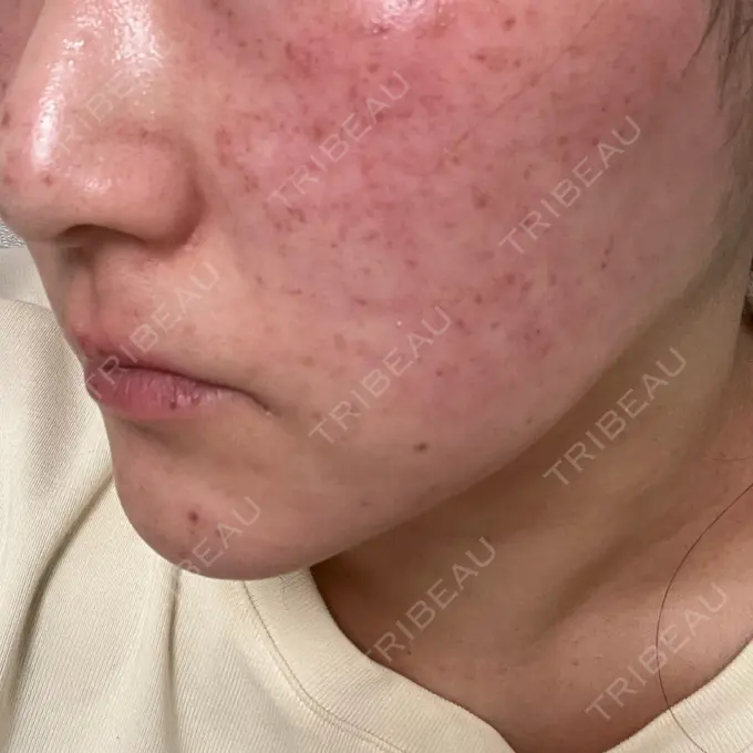 ルビーレーザー Designo Clinic （デジーノクリニック） DAY 0 メイン用