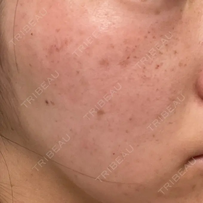 ルビーレーザー Designo Clinic （デジーノクリニック） DAY 1 メイン用