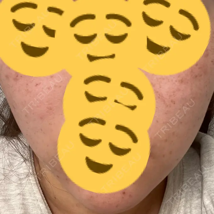 ルビーレーザー Designo Clinic （デジーノクリニック） DAY 1 メイン用