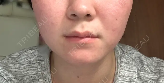 ボトックス（エラ・小顔） アリエル美容クリニック 横浜院 DAY 7 メイン用