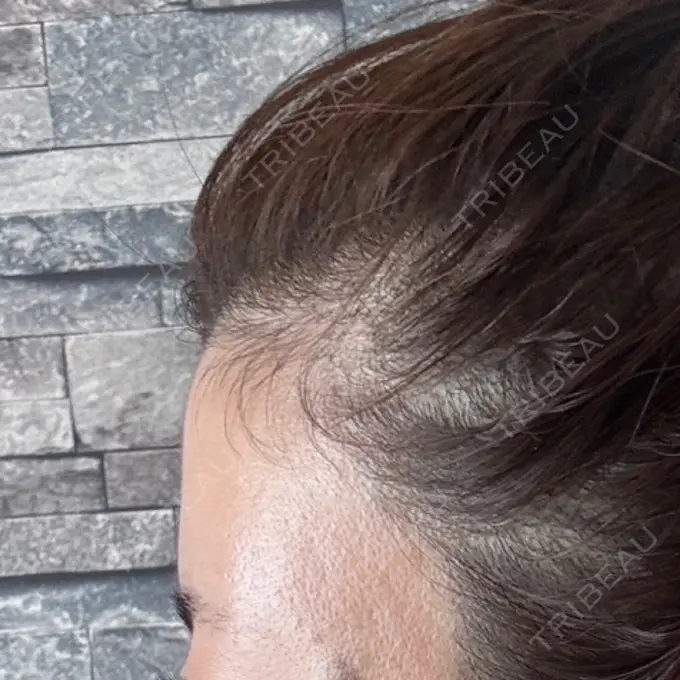 脂肪注入（額） / ボトックス（額） Bloom Delight Clinic AFTER メイン用