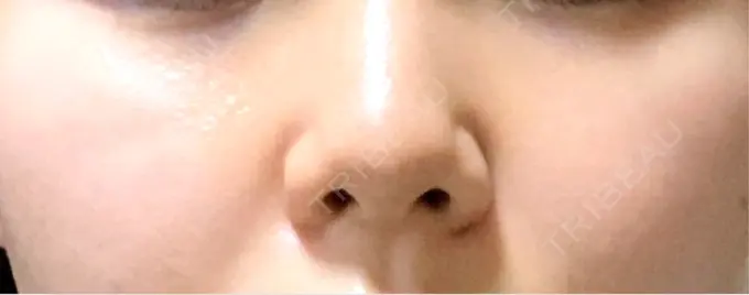 ヒアルロン酸注入（鼻） / ヒアルロン酸注入（頬） オアシス美容外科 AFTER メイン用