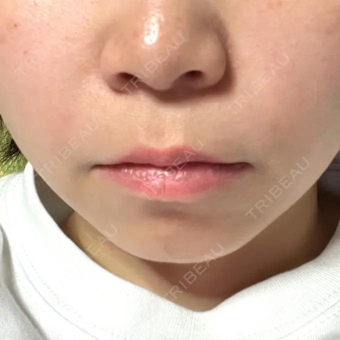 ボトックス（口角） / ボトックス（ガミースマイル） ルラ美容クリニック 渋谷本院 DAY 0 メイン用