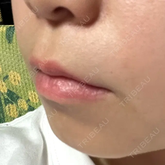 ボトックス（口角） / ボトックス（ガミースマイル） ルラ美容クリニック 渋谷本院 DAY 0 メイン用