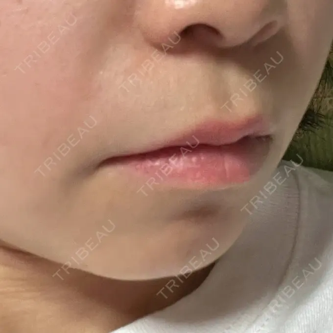 ボトックス（口角） / ボトックス（ガミースマイル） ルラ美容クリニック 渋谷本院 DAY 0 メイン用