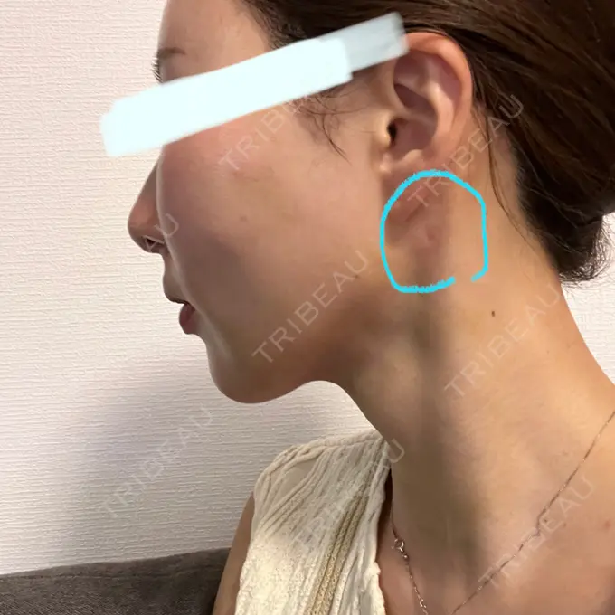 糸リフト / 脂肪吸引（顔） / 額を丸く / 脂肪注入（額） / ジョールファット除去 / 脂肪吸引注射（顔） / 脂肪注入（輪郭） / 美容点滴・美容注射（疲労回復） / その他 SEA CLINIC（シークリニック） DAY 7 メイン用