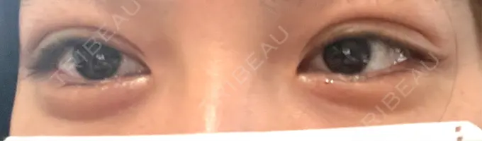 二重埋没 HAAB×DREAM BEAUTY CLINIC 大阪梅田院 DAY 0 メイン用