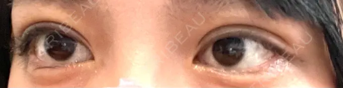 二重埋没 HAAB×DREAM BEAUTY CLINIC 大阪梅田院 DAY 2 メイン用