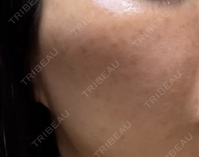 イオン導入 / ピーリング（ハリ・ツヤ） / ルメッカ ルラ美容クリニック 名古屋栄院 / ルラスキンクリニック 名古屋栄院 DAY 12 メイン用