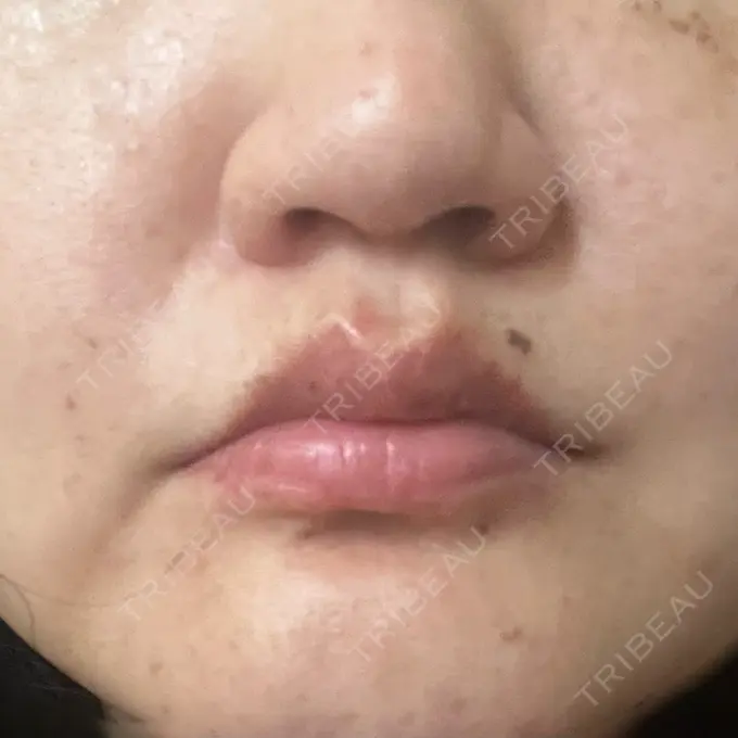 ピコレーザートーニング（美白・肝斑） 東京シルククリニック 東京神田院 AFTER メイン用