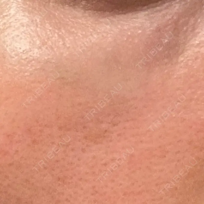 リジュラン 湘南美容クリニック 広島院 AFTER メイン用