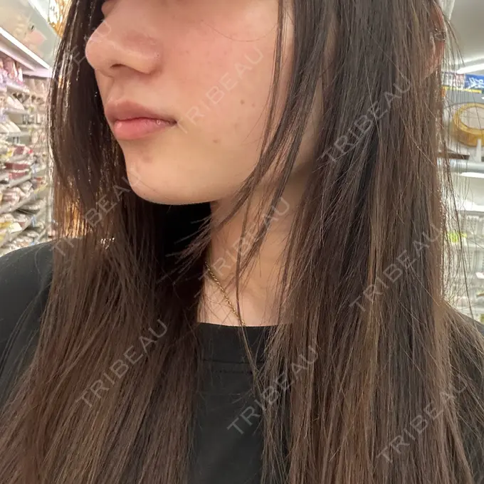 ヒアルロン酸注入（あご） ルラ美容クリニック 渋谷本院 AFTER メイン用