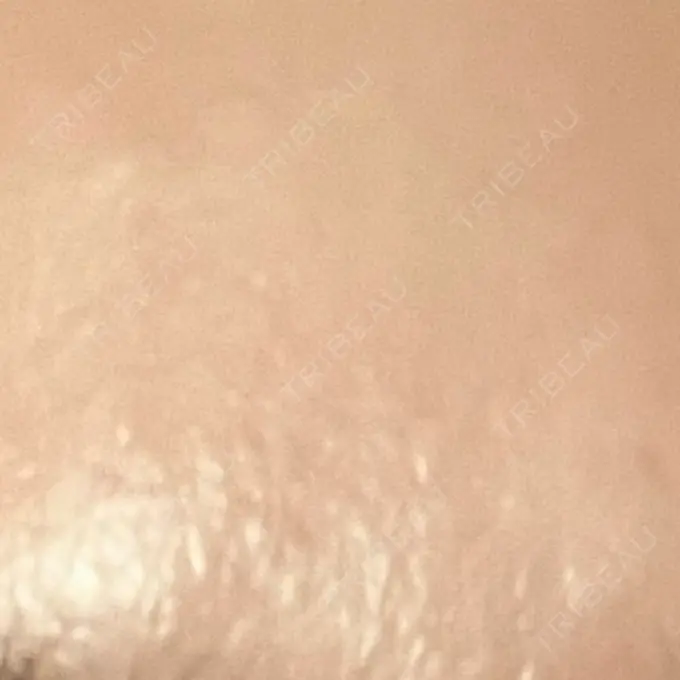 高濃度ビタミンC点滴 新宿美容外科ネビュラクリニック DAY 2 メイン用