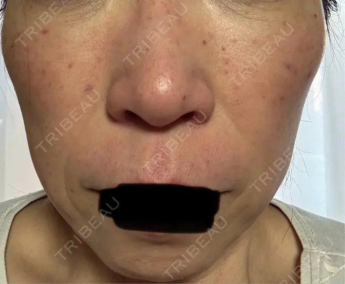 シワ取りボトックス / マイクロボトックス 湘南美容クリニック 名古屋駅本院 DAY 2 メイン用