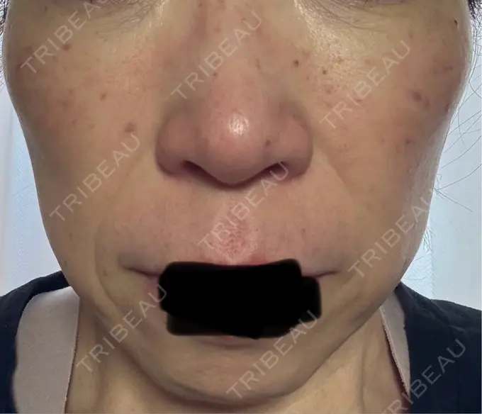 シワ取りボトックス / マイクロボトックス 湘南美容クリニック 名古屋駅本院 DAY 3 メイン用