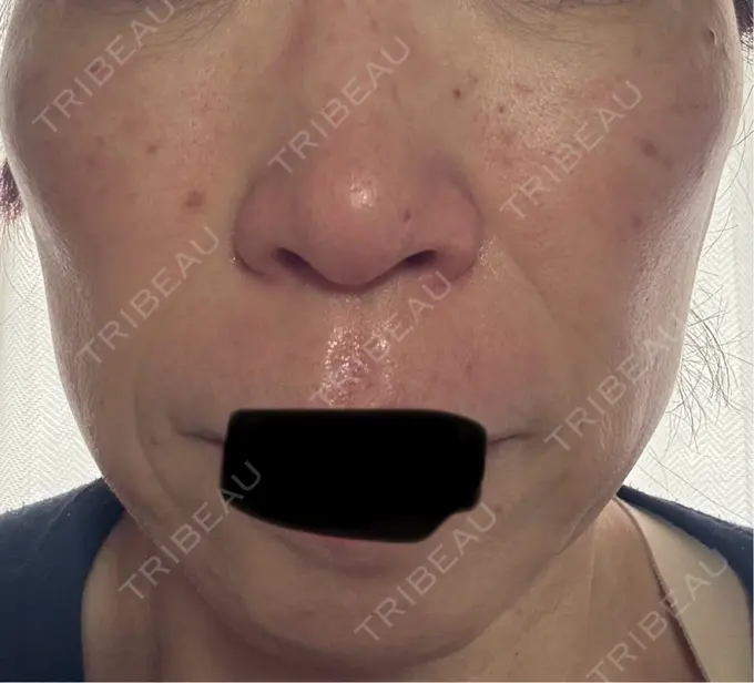 シワ取りボトックス / マイクロボトックス 湘南美容クリニック 名古屋駅本院 DAY 4 メイン用