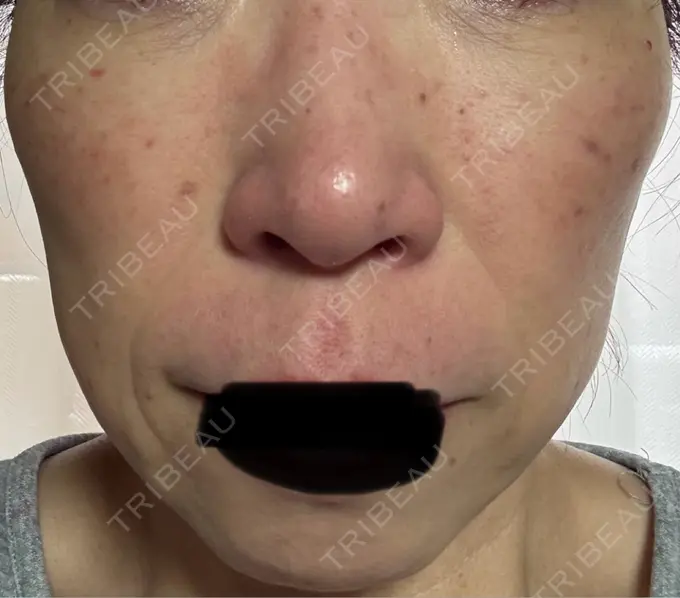 シワ取りボトックス / マイクロボトックス 湘南美容クリニック 名古屋駅本院 DAY 5 メイン用