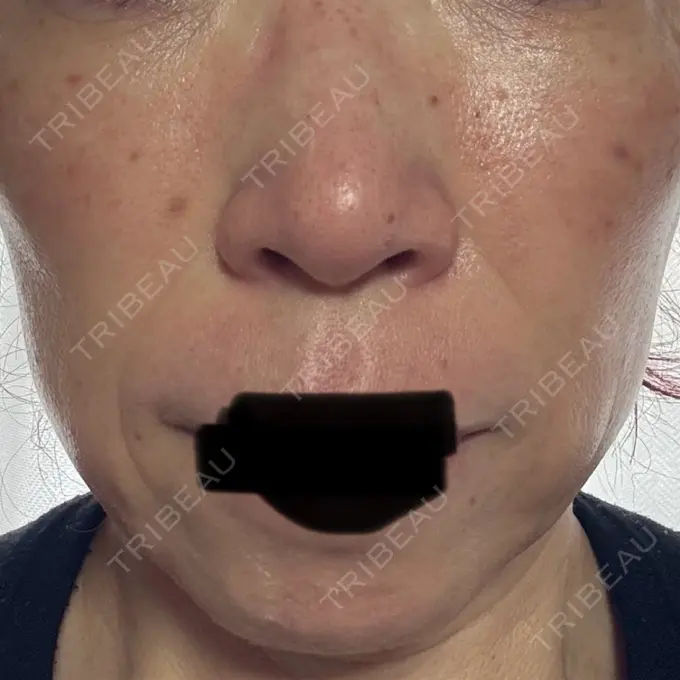 シワ取りボトックス / マイクロボトックス 湘南美容クリニック 名古屋駅本院 DAY 6 メイン用