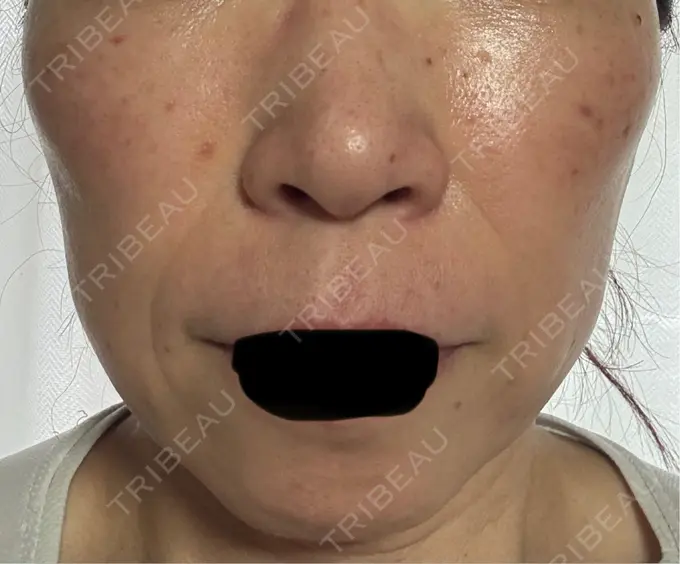 シワ取りボトックス / マイクロボトックス 湘南美容クリニック 名古屋駅本院 DAY 7 メイン用