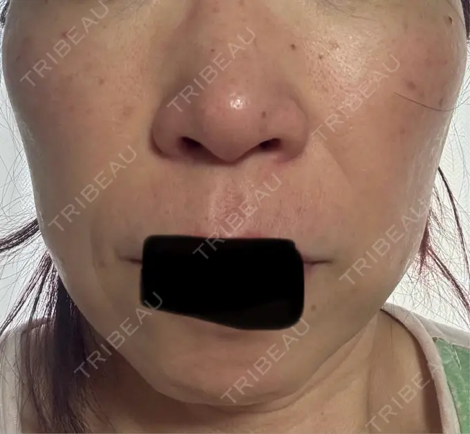 シワ取りボトックス / マイクロボトックス 湘南美容クリニック 名古屋駅本院 DAY 8 メイン用