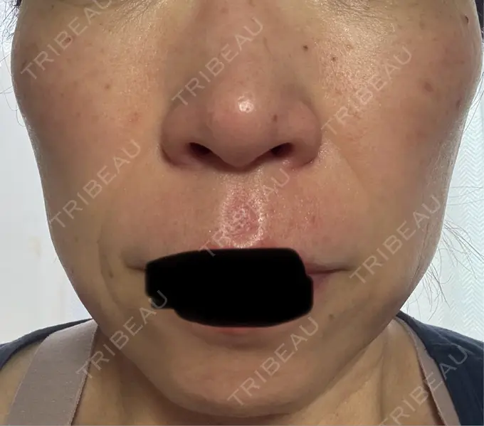 シワ取りボトックス / マイクロボトックス 湘南美容クリニック 名古屋駅本院 DAY 10 メイン用