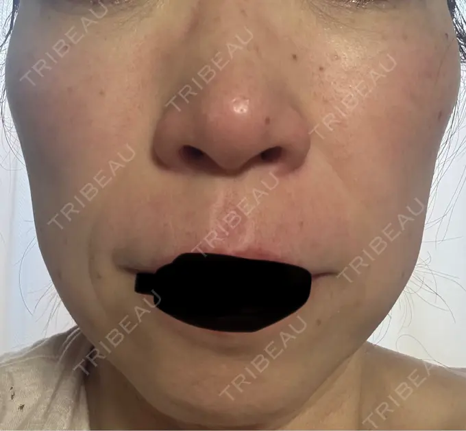 シワ取りボトックス / マイクロボトックス 湘南美容クリニック 名古屋駅本院 AFTER メイン用